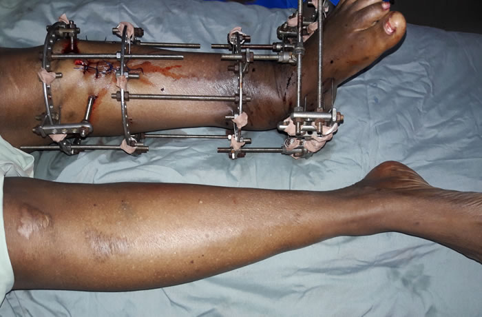 The Challenge of Orthopedic and Trauma Practice in Nigeria - Hopeville Specialist Hospital